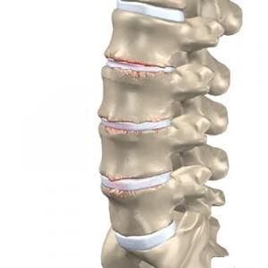 Ledvena hrbtenica z očitnimi manifestacijami osteohondroze