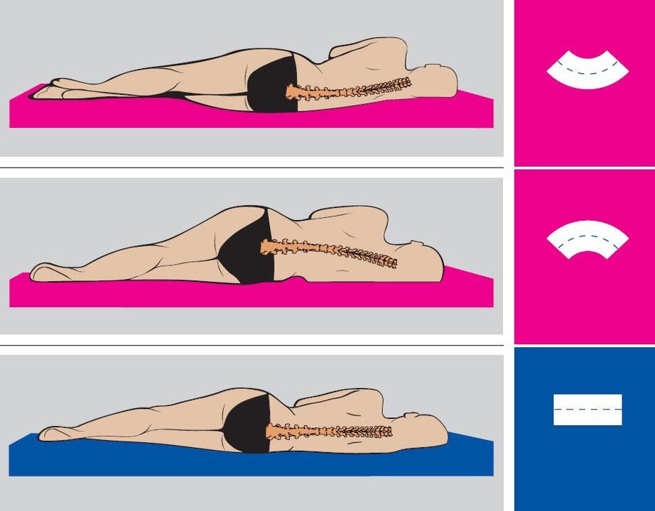 Pravilen položaj telesa med spanjem z ledveno osteohondrozo
