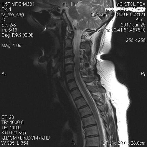 Osteohondroza in spondiloza vratne hrbtenice