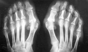 Diferencialna diagnoza simptomov artritisa in artroze