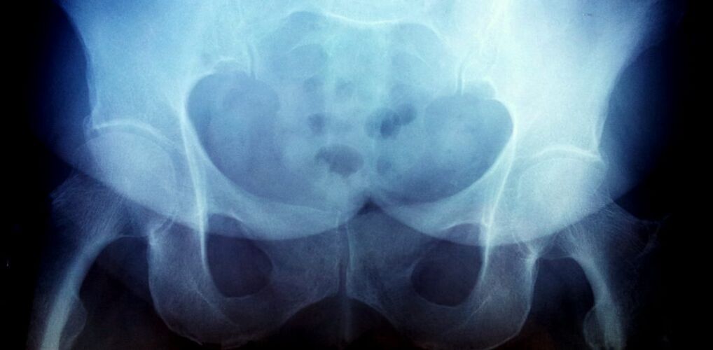 X -ray slika z artrozo 2. stopnje